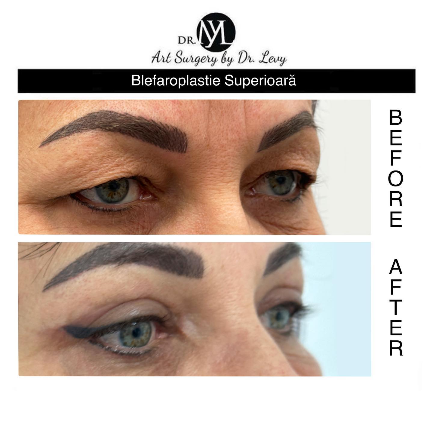 poze operatie blefaroplastie superioara