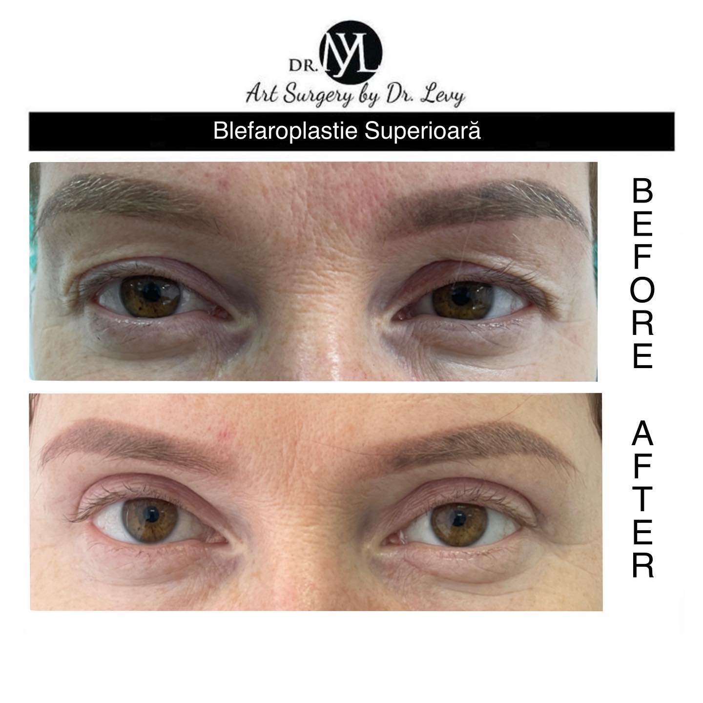 poze operatie blefaroplastie superioara