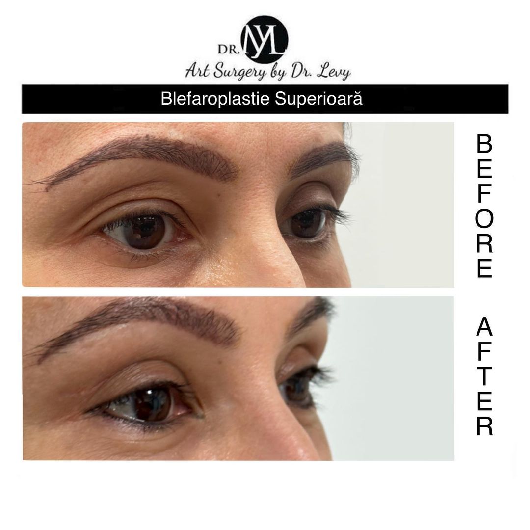 poze operatie blefaroplastie superioara