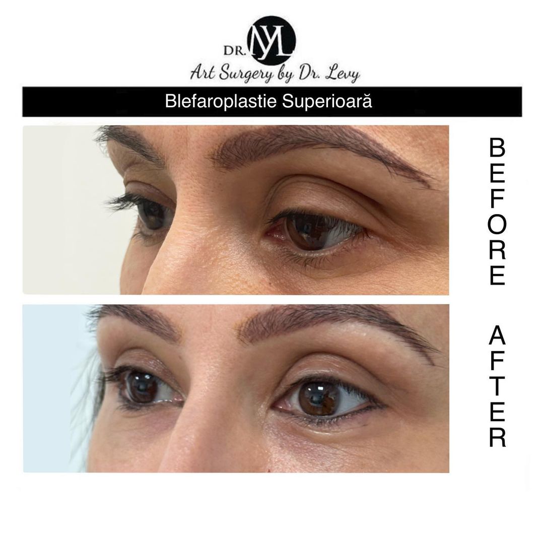 poze operatie blefaroplastie superioara