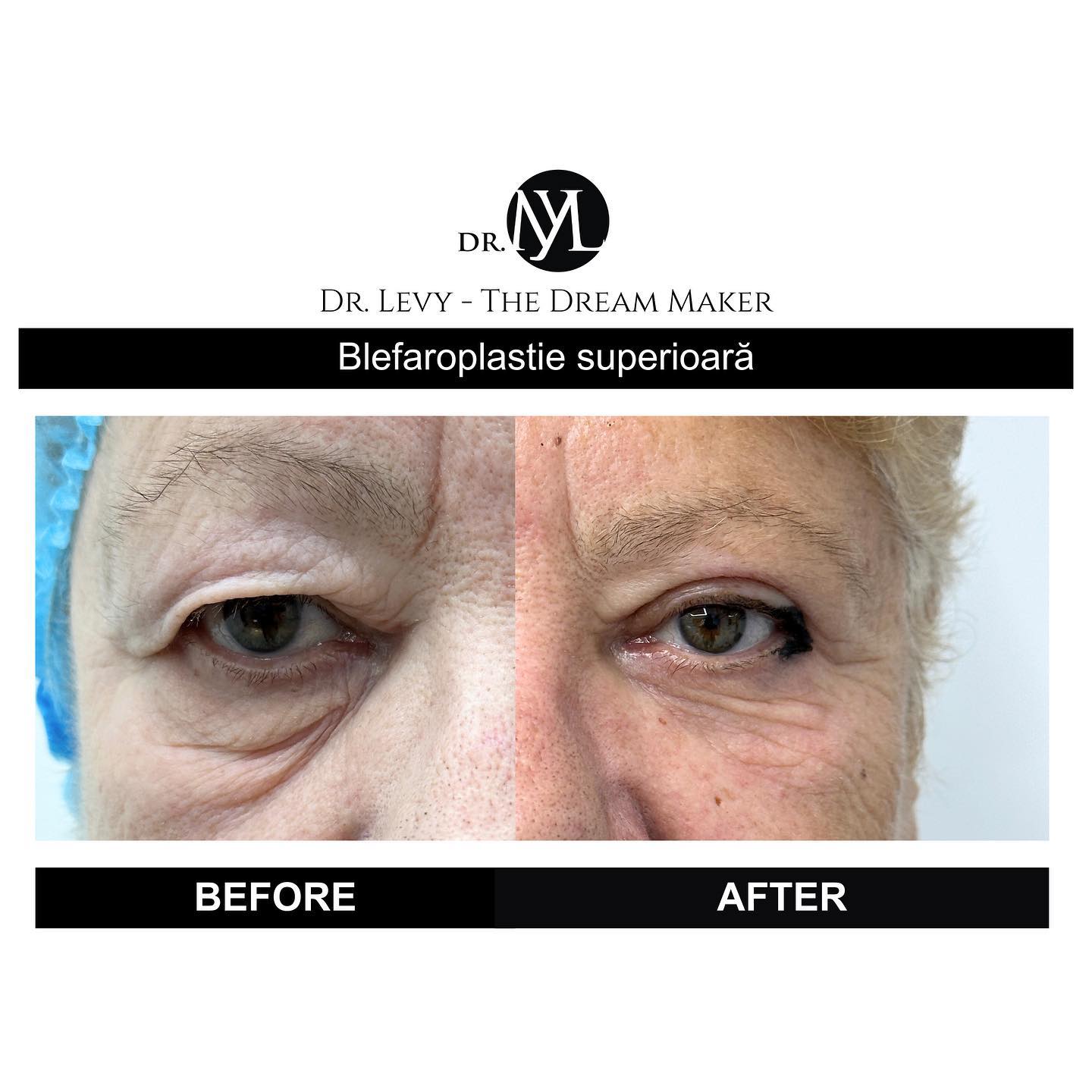 poze operatie blefaroplastie superioara