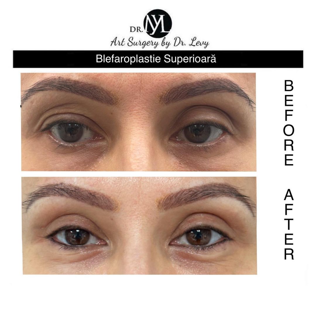 poze operatie blefaroplastie superioara