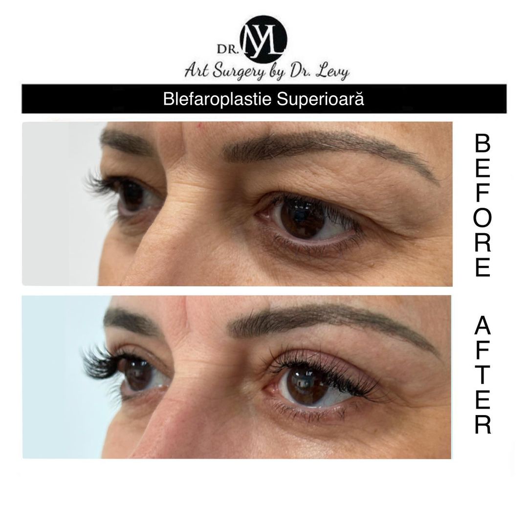 poze operatie blefaroplastie superioara