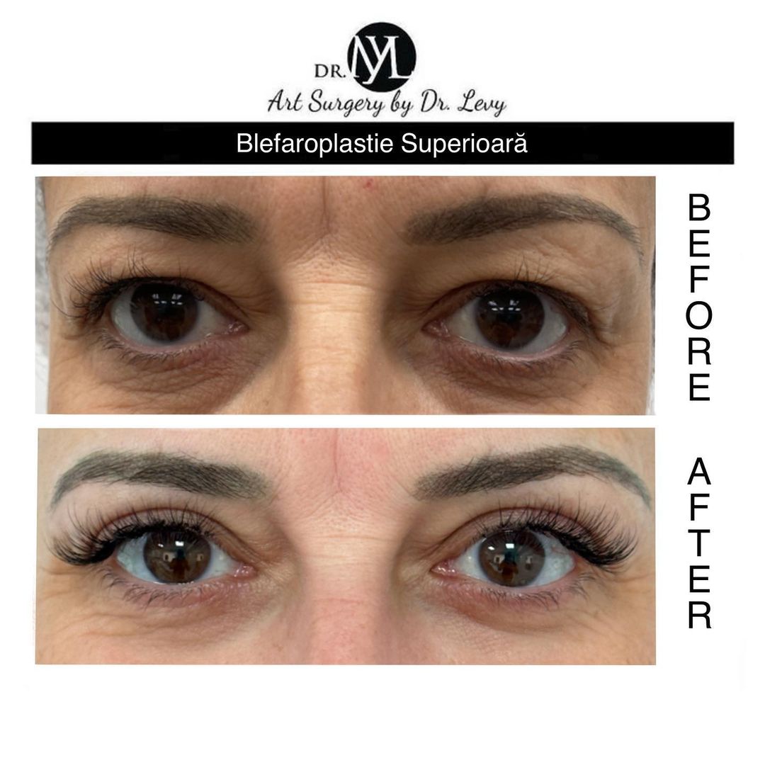 poze operatie blefaroplastie superioara