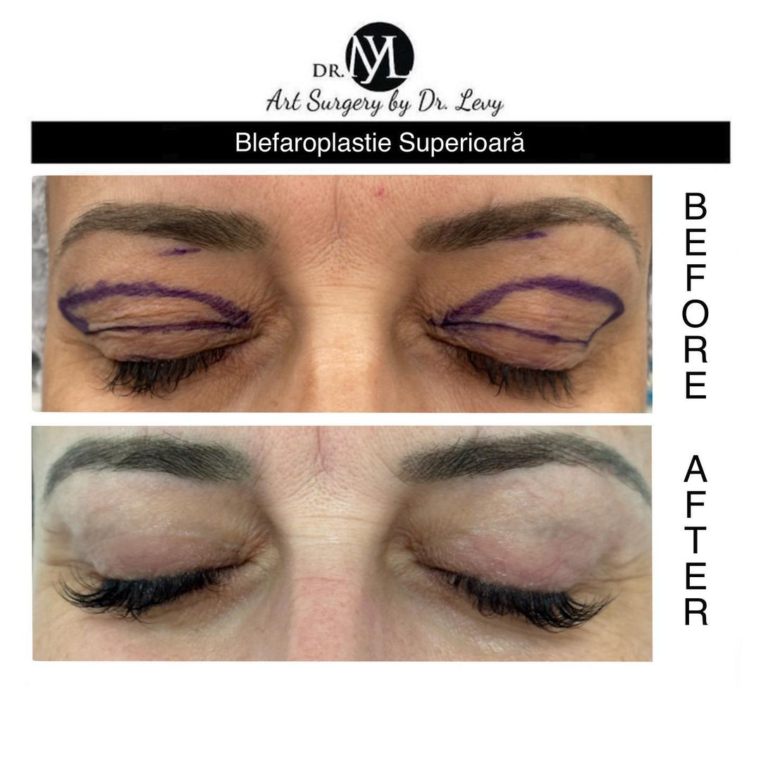 poze operatie blefaroplastie superioara