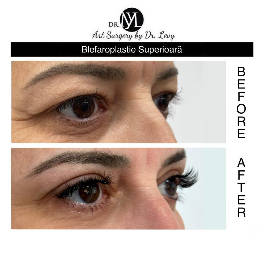 poze operatie blefaroplastie superioara