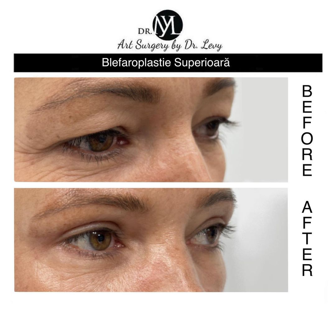 poze operatie blefaroplastie superioara