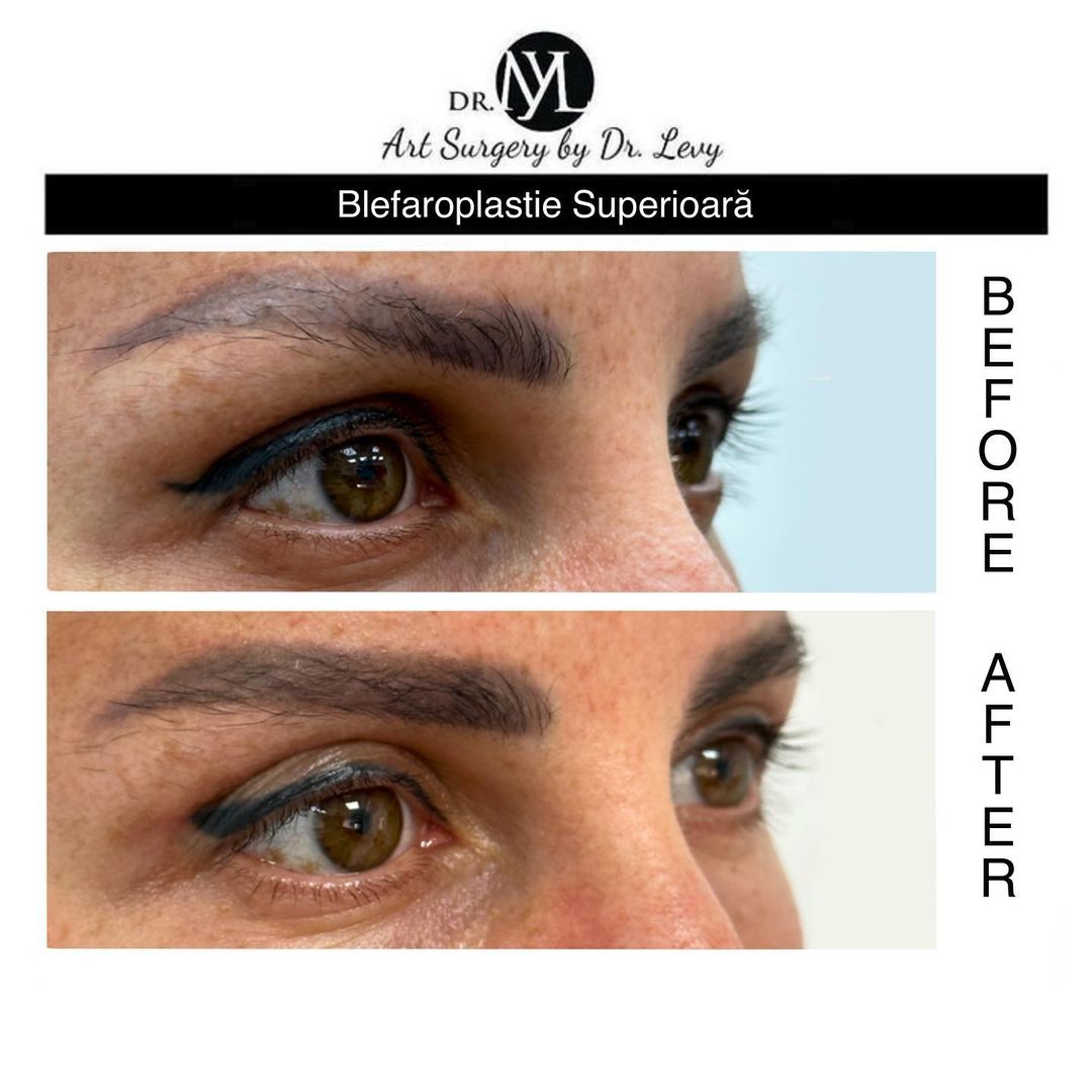 poze operatie blefaroplastie superioara