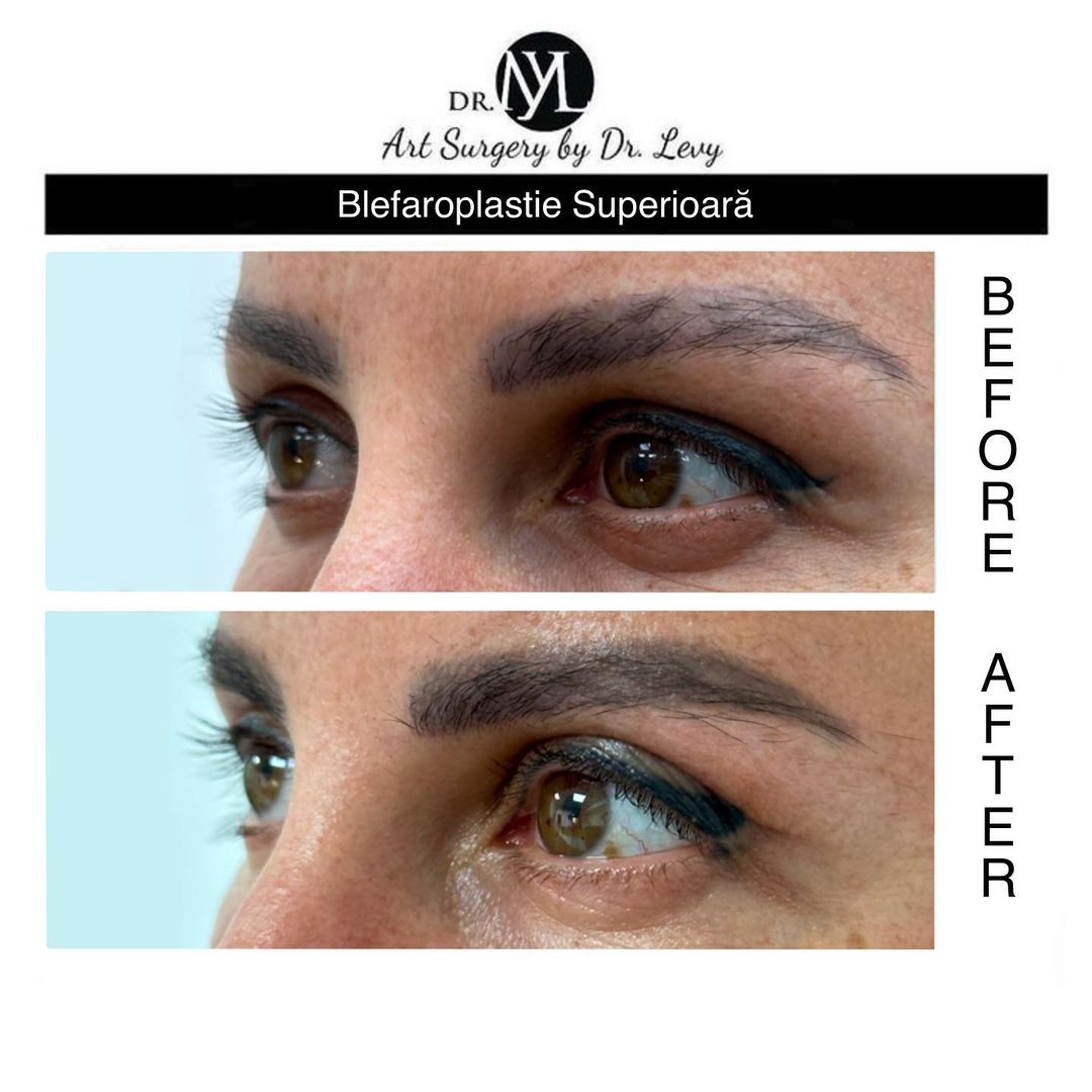 poze operatie blefaroplastie superioara