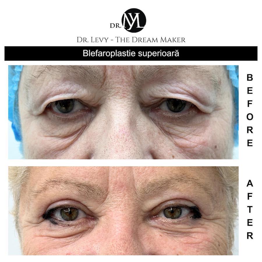 poze operatie blefaroplastie superioara
