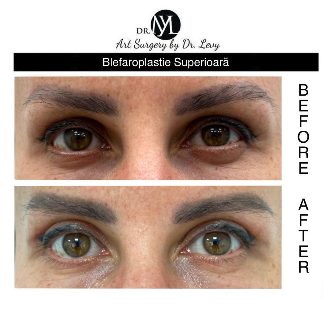 poze operatie blefaroplastie superioara
