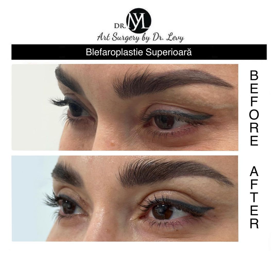 poze operatie blefaroplastie superioara