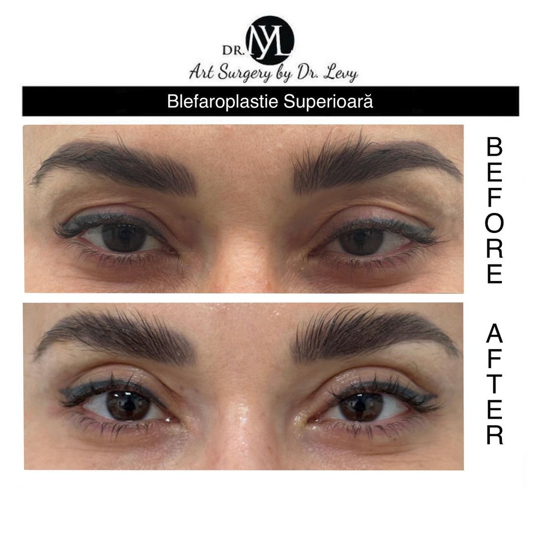 poze operatie blefaroplastie superioara