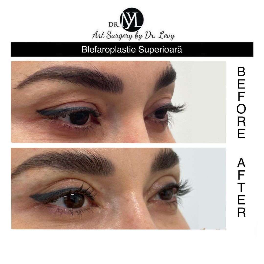 poze operatie blefaroplastie superioara