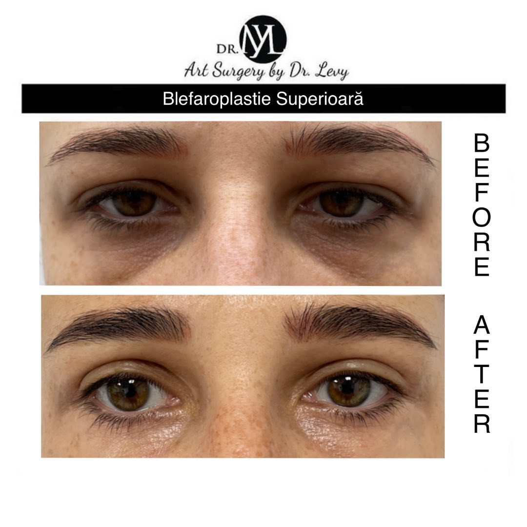 poze operatie blefaroplastie superioara