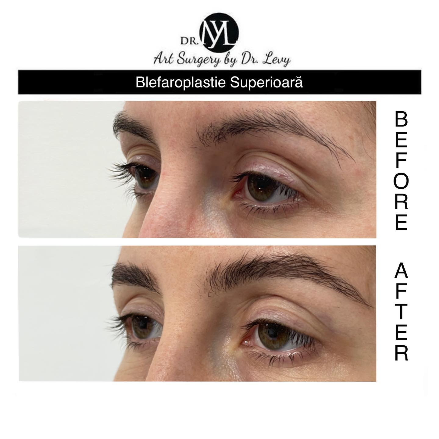 poze operatie blefaroplastie superioara