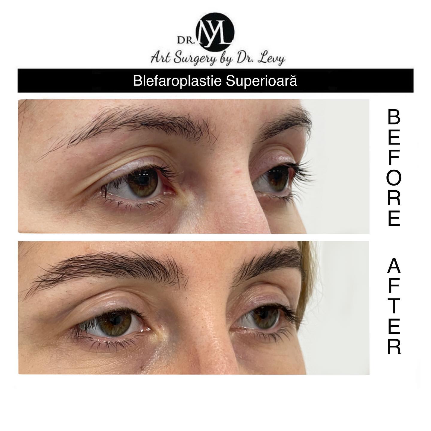 poze operatie blefaroplastie superioara