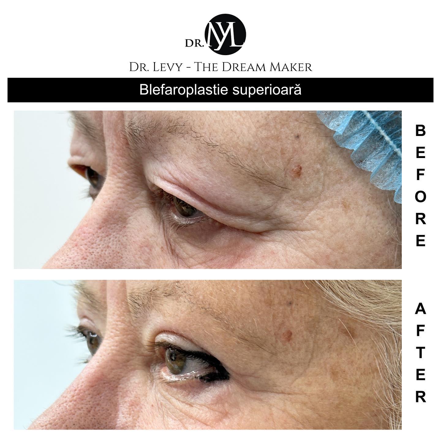 poze operatie blefaroplastie superioara