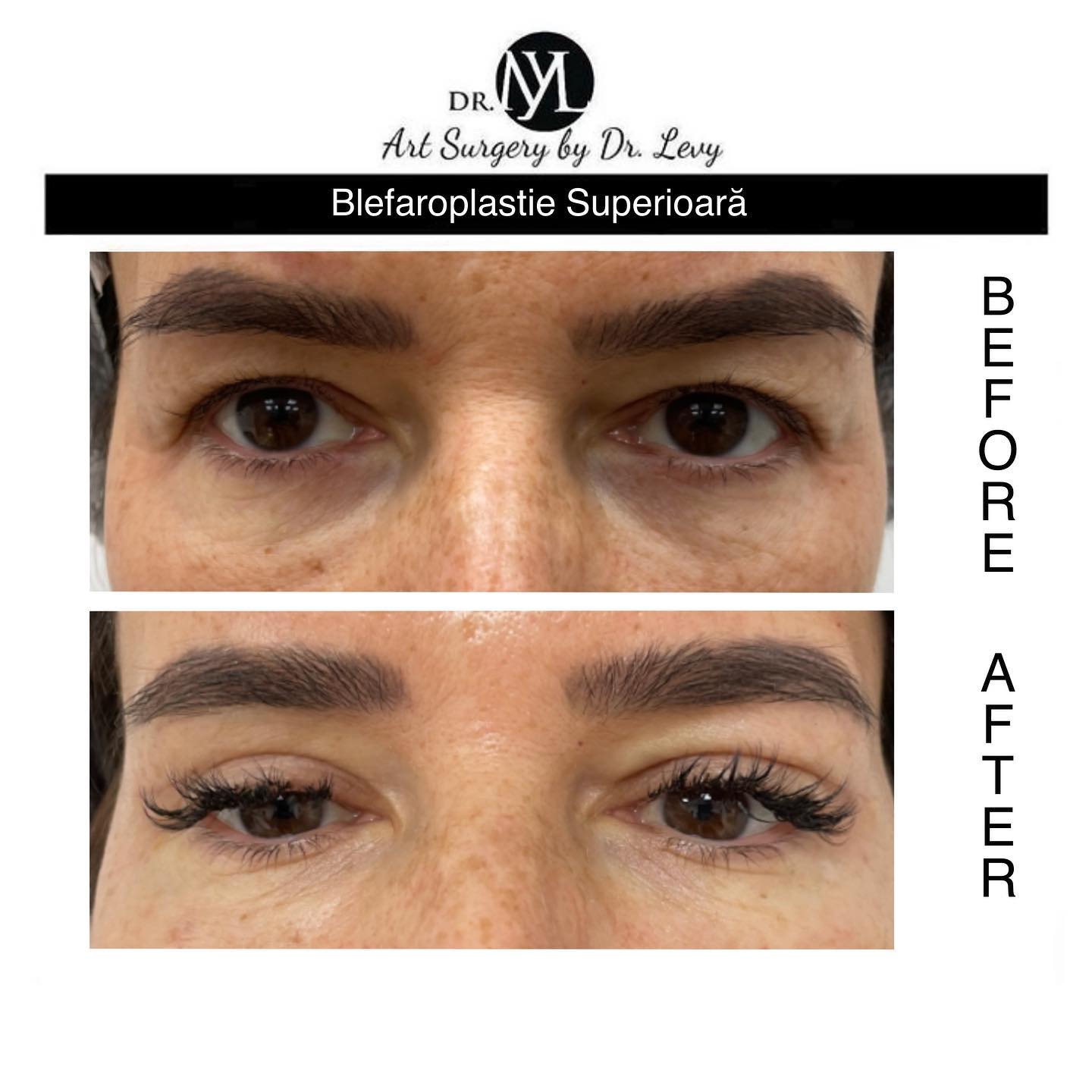 poze operatie blefaroplastie superioara