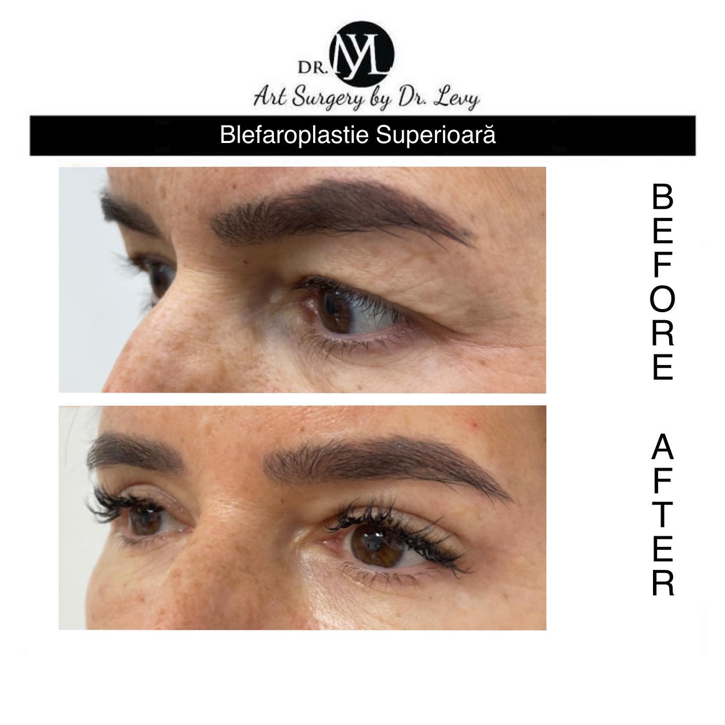 poze operatie blefaroplastie superioara