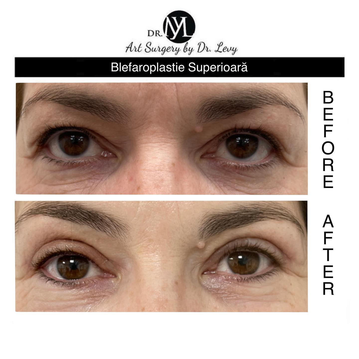 poze operatie blefaroplastie superioara