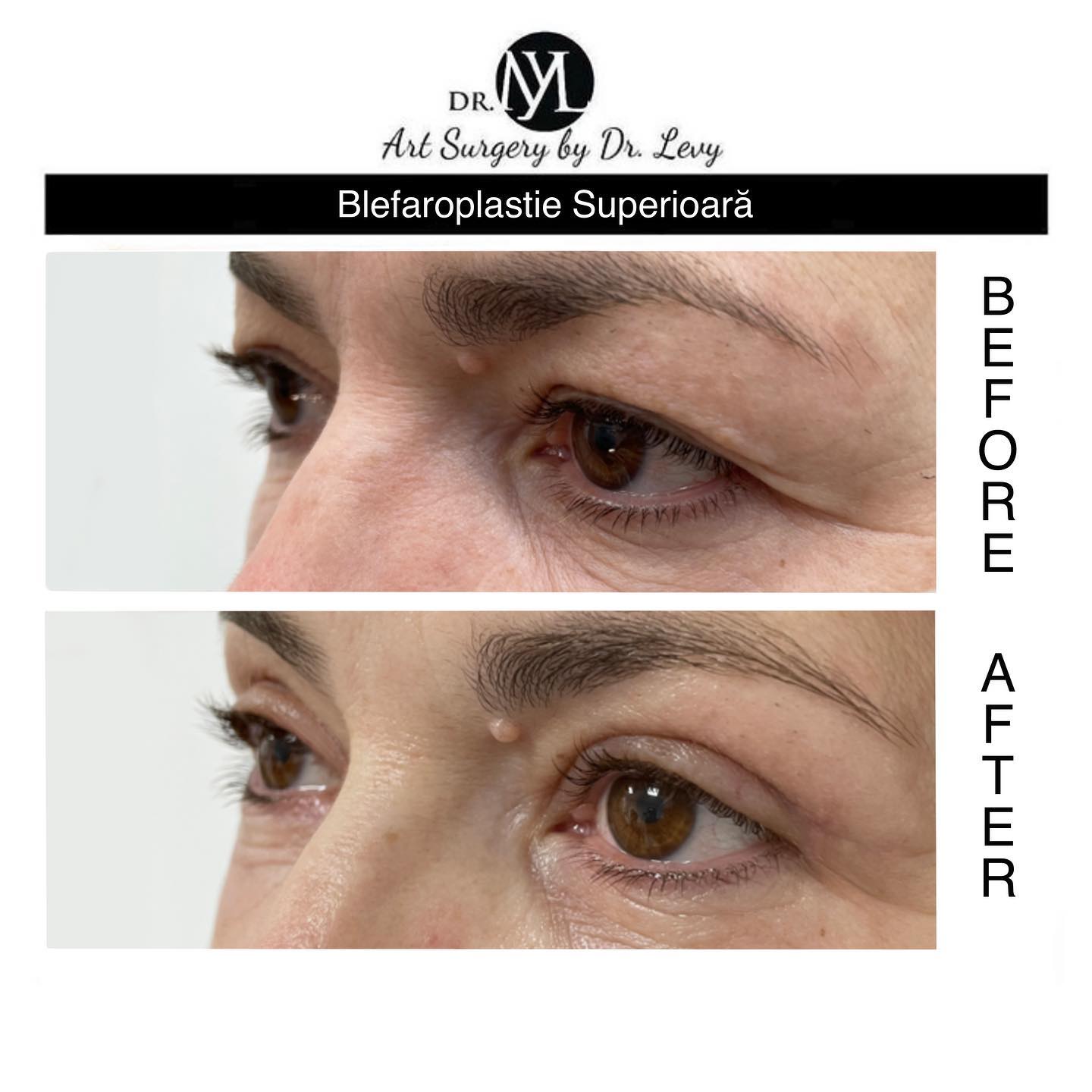 poze operatie blefaroplastie superioara