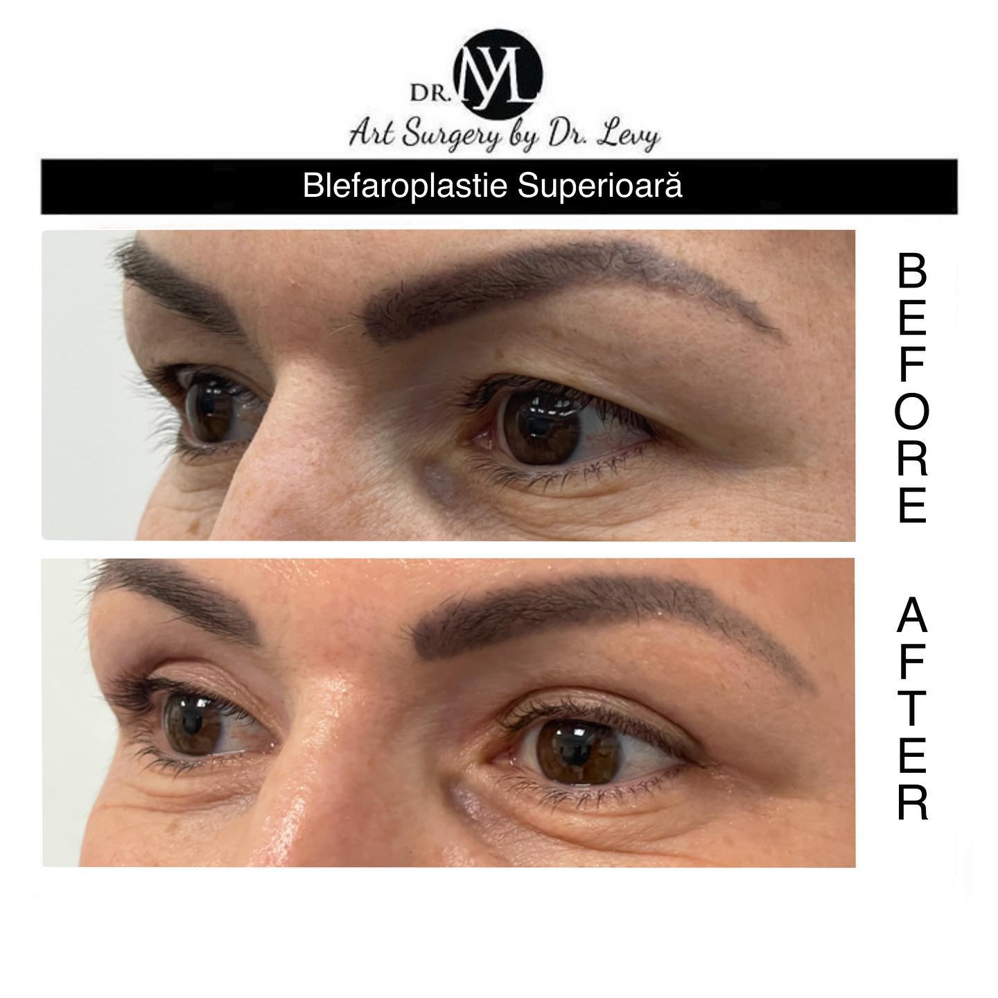 poze operatie blefaroplastie superioara