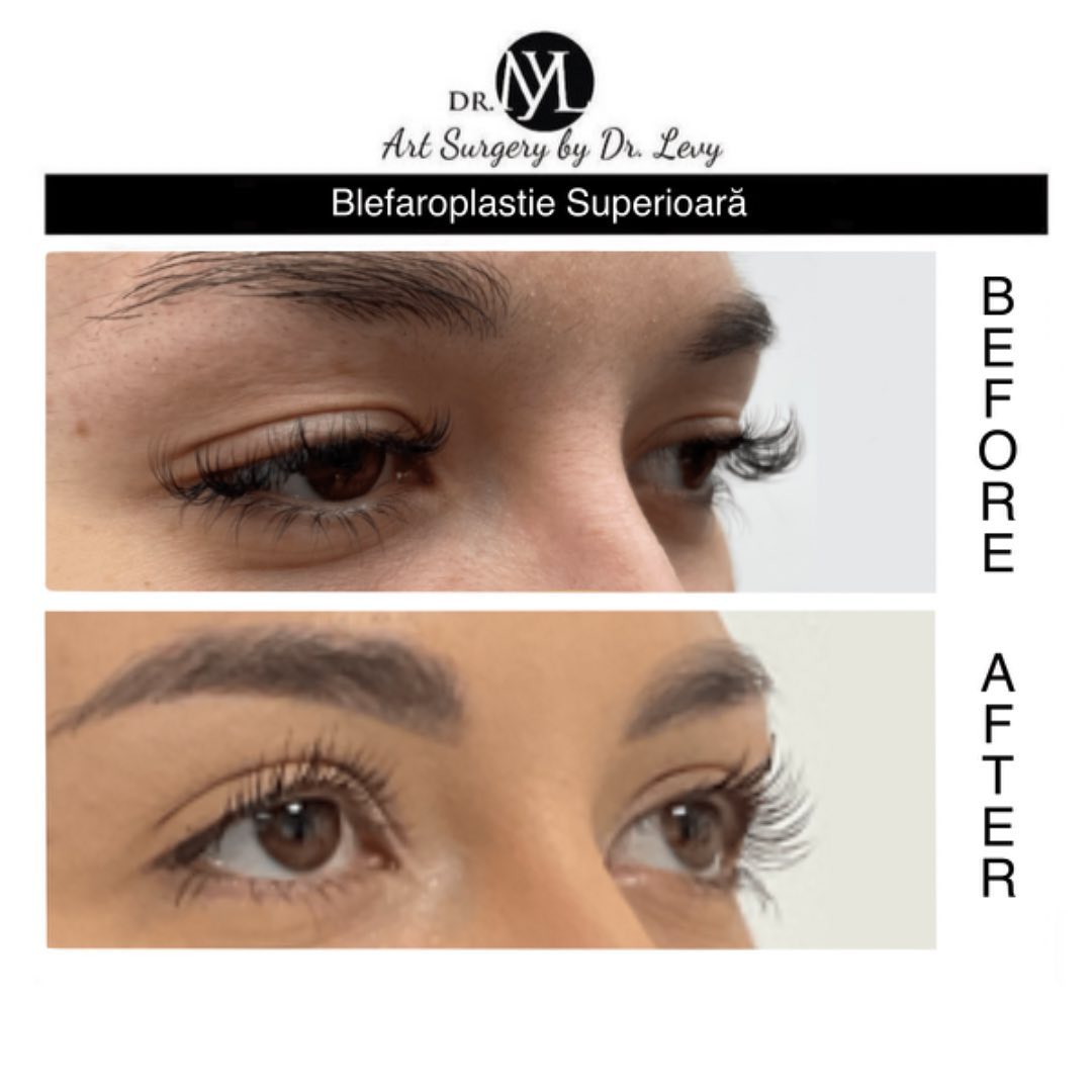 poze operatie blefaroplastie superioara