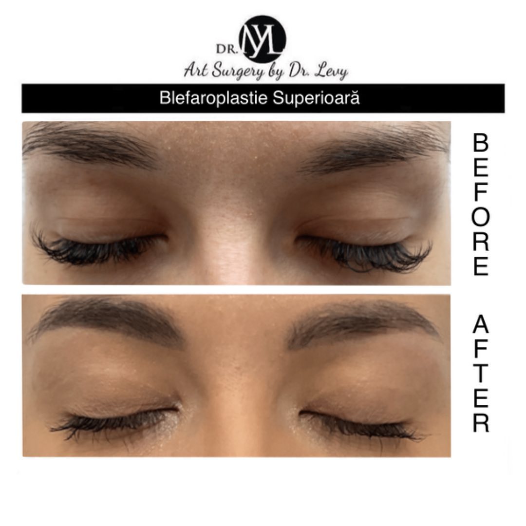 poze operatie blefaroplastie superioara