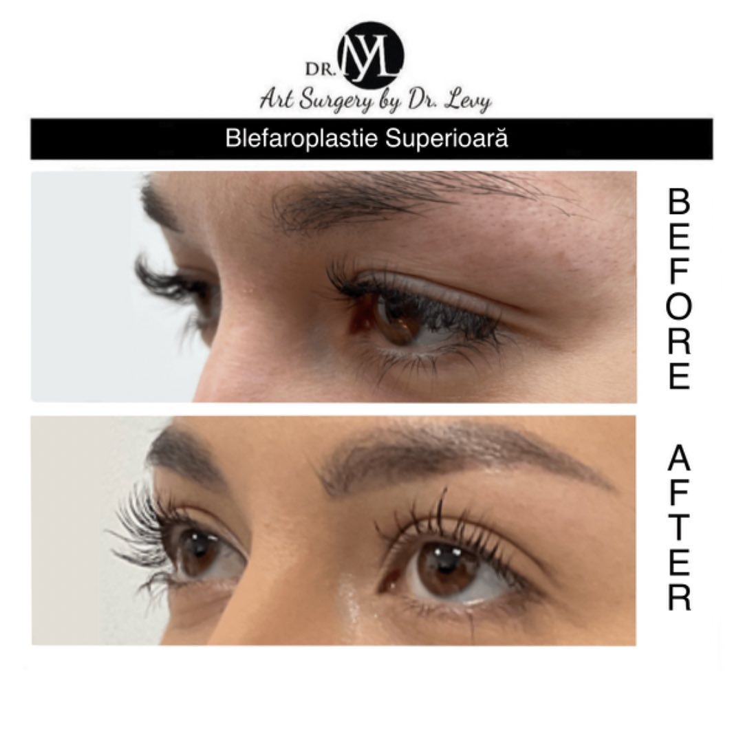 poze operatie blefaroplastie superioara
