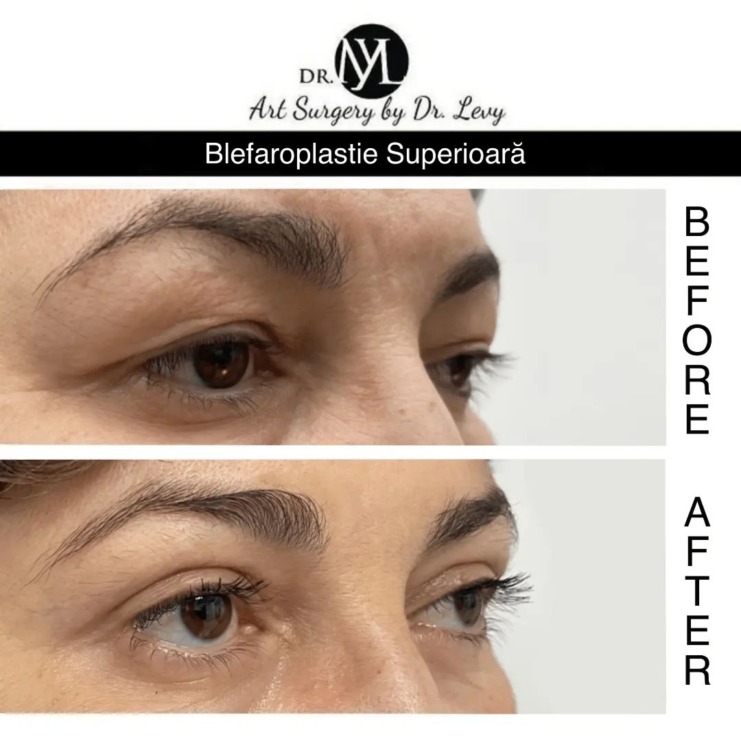poze operatie blefaroplastie superioara
