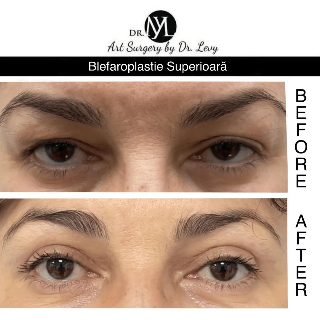 poze operatie blefaroplastie superioara