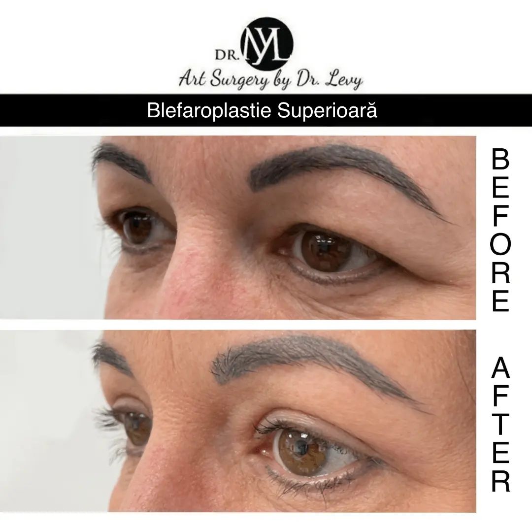 poze operatie blefaroplastie superioara