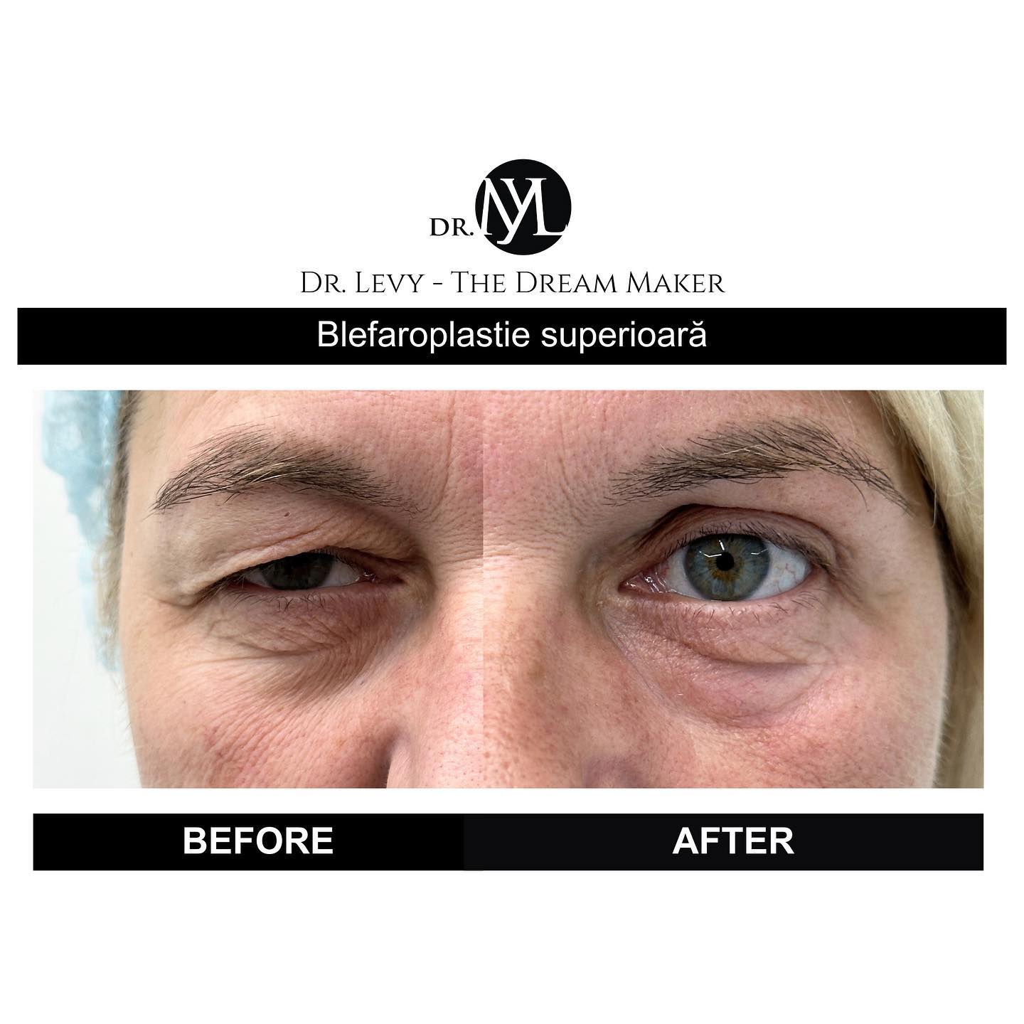 poze operatie blefaroplastie superioara