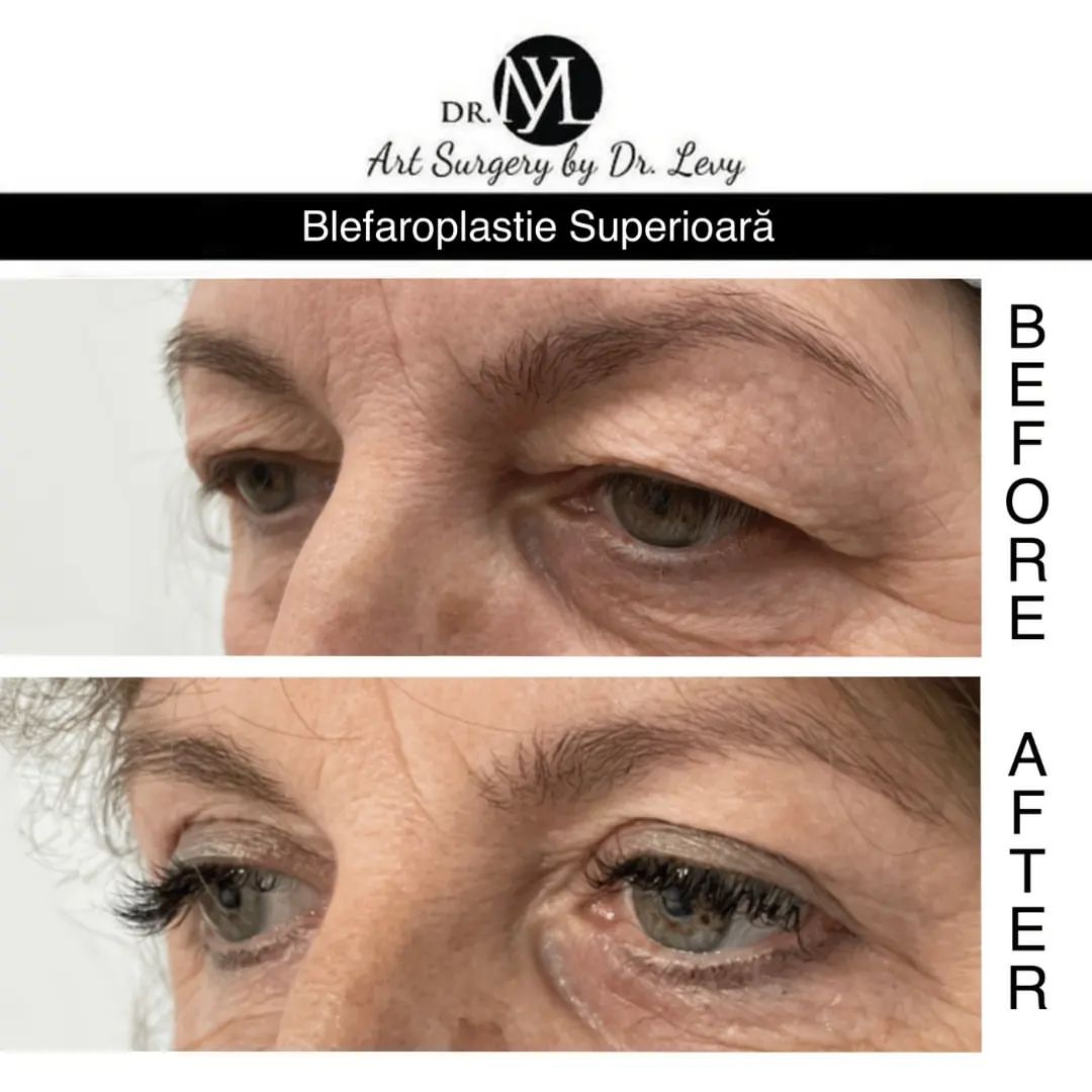 poze operatie blefaroplastie superioara