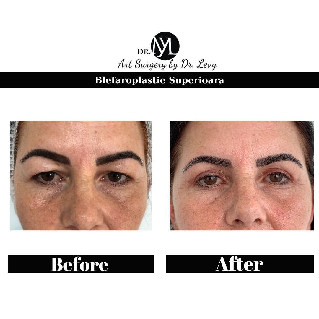 poze operatie blefaroplastie superioara