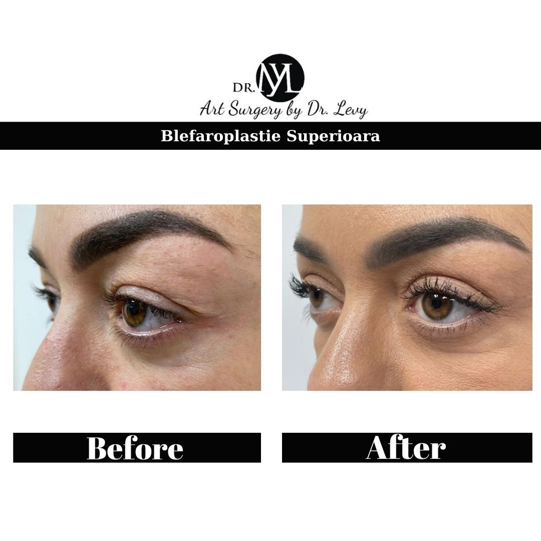 poze operatie blefaroplastie superioara