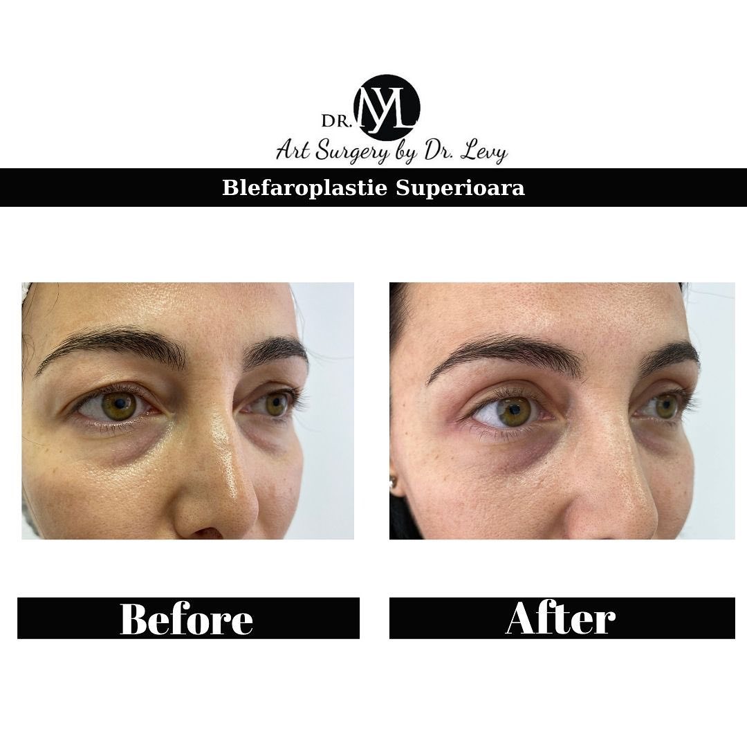 poze operatie blefaroplastie superioara