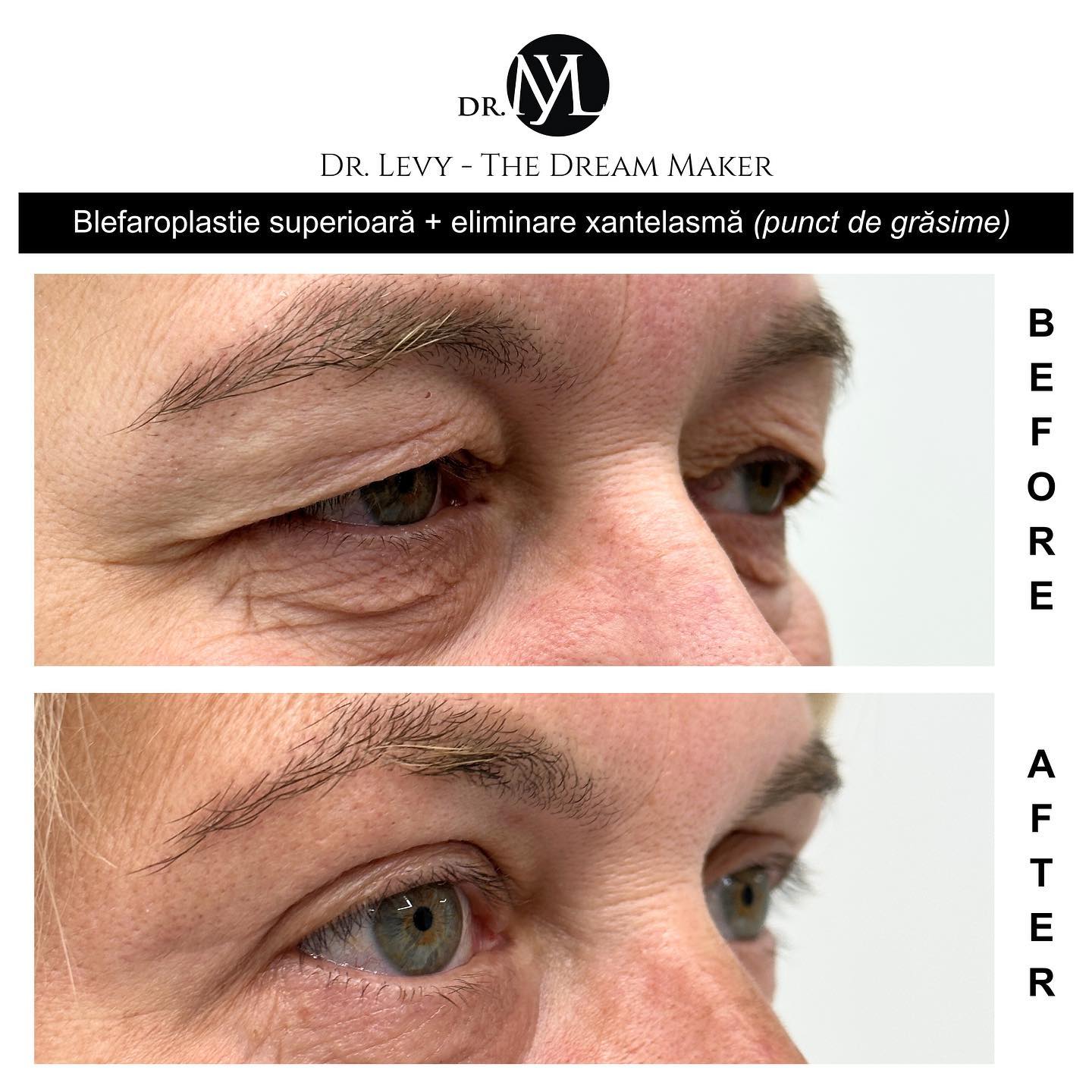 poze operatie blefaroplastie superioara