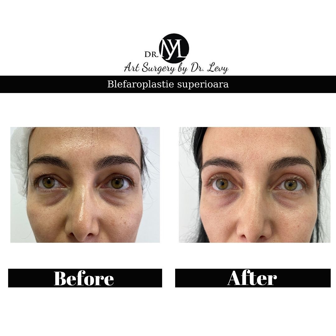 poze operatie blefaroplastie superioara