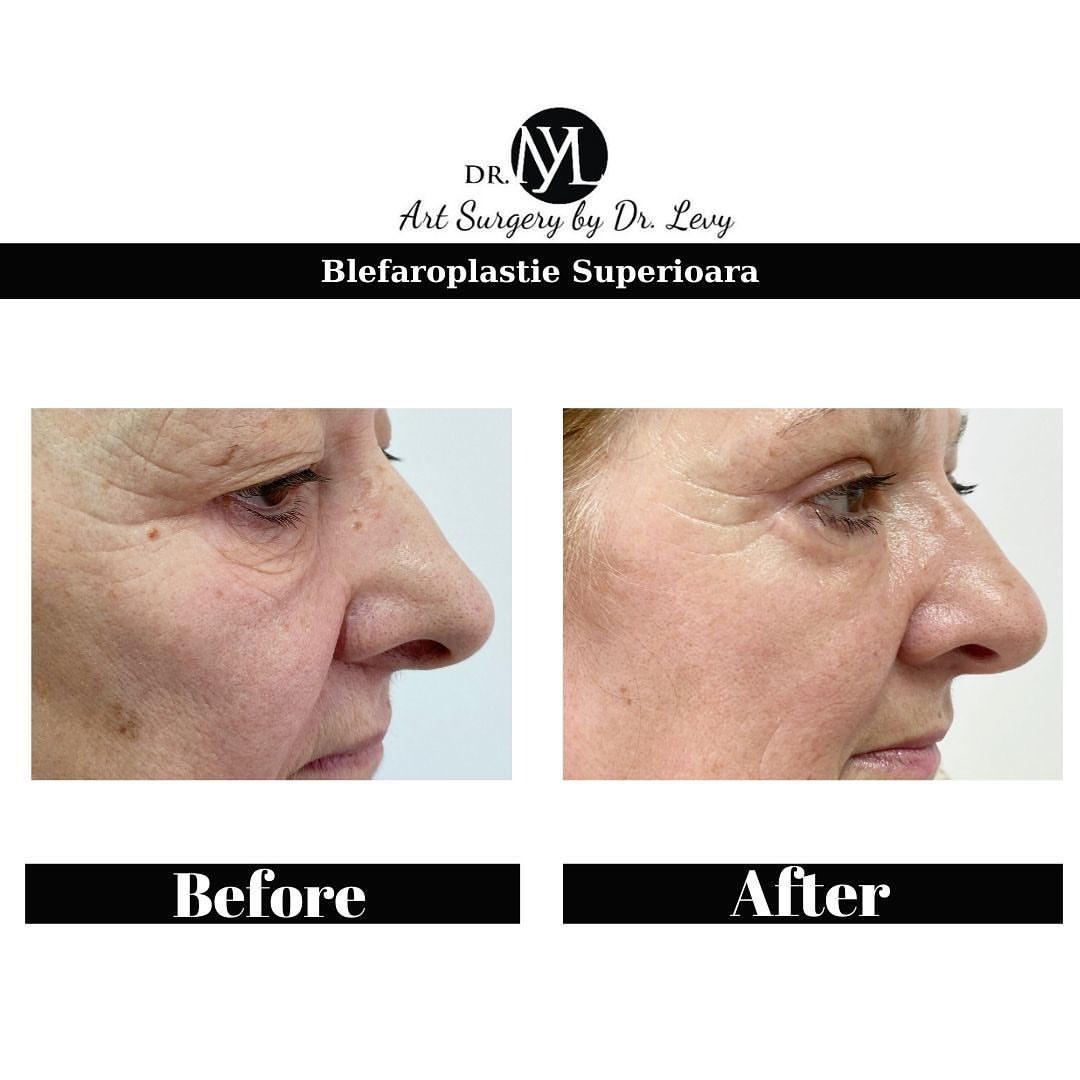 poze operatie blefaroplastie superioara