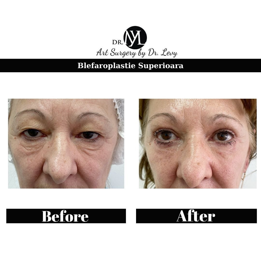 poze operatie blefaroplastie superioara