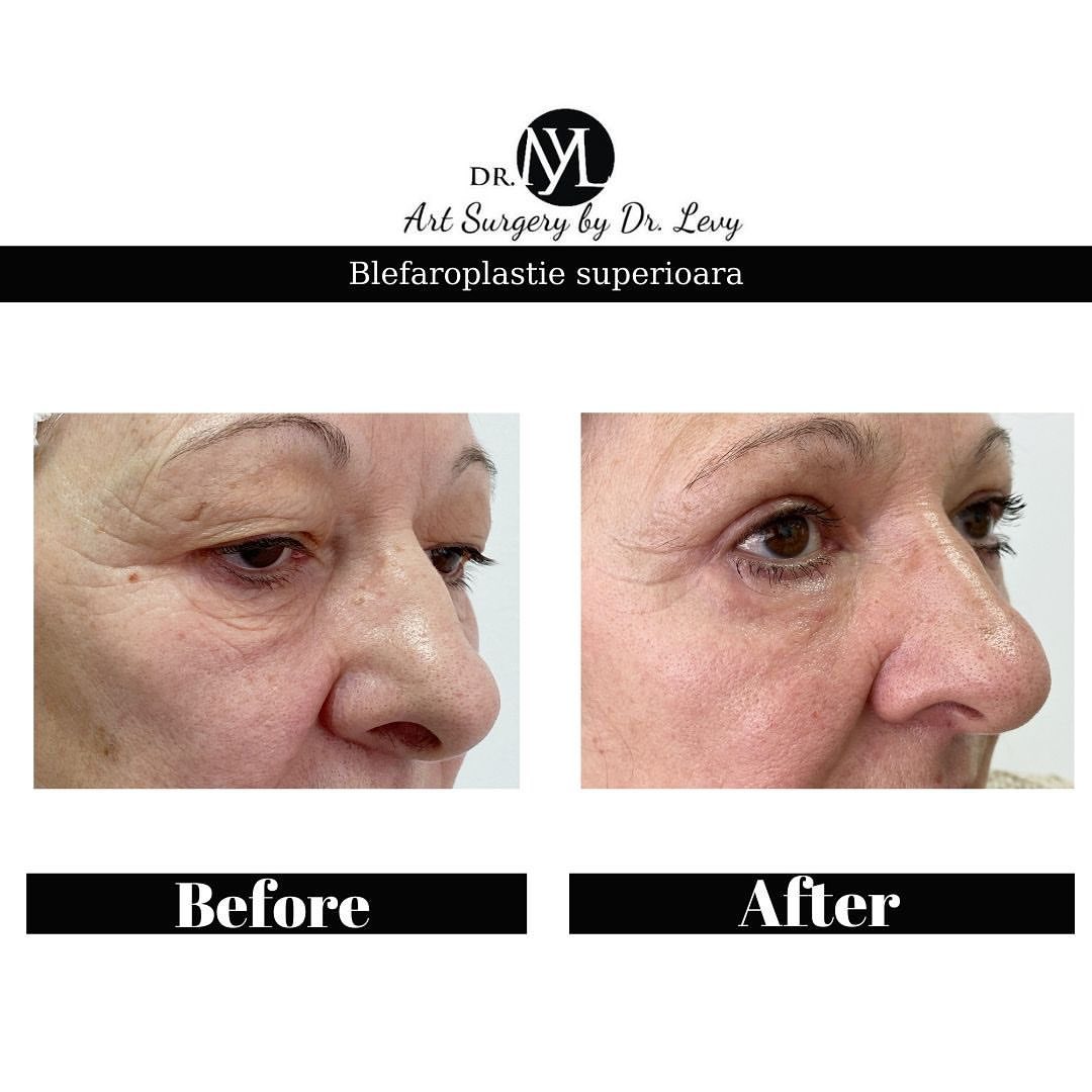 poze operatie blefaroplastie superioara
