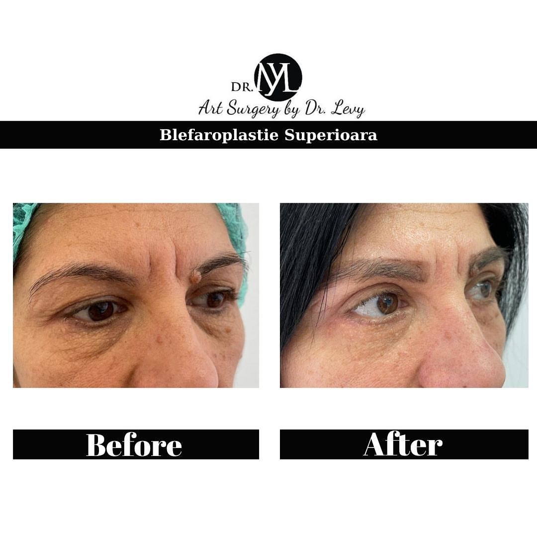 poze operatie blefaroplastie superioara