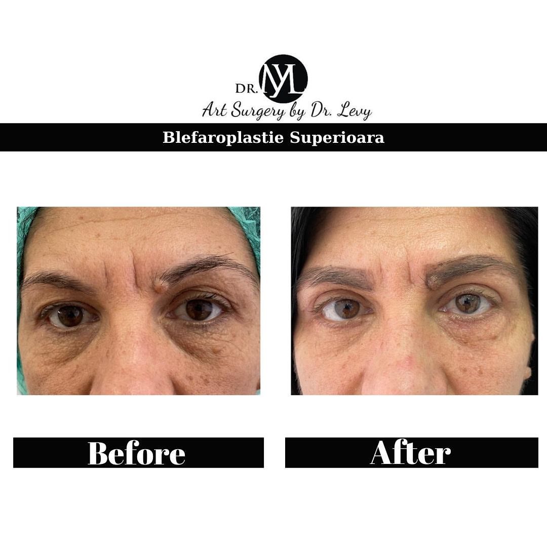 poze operatie blefaroplastie superioara