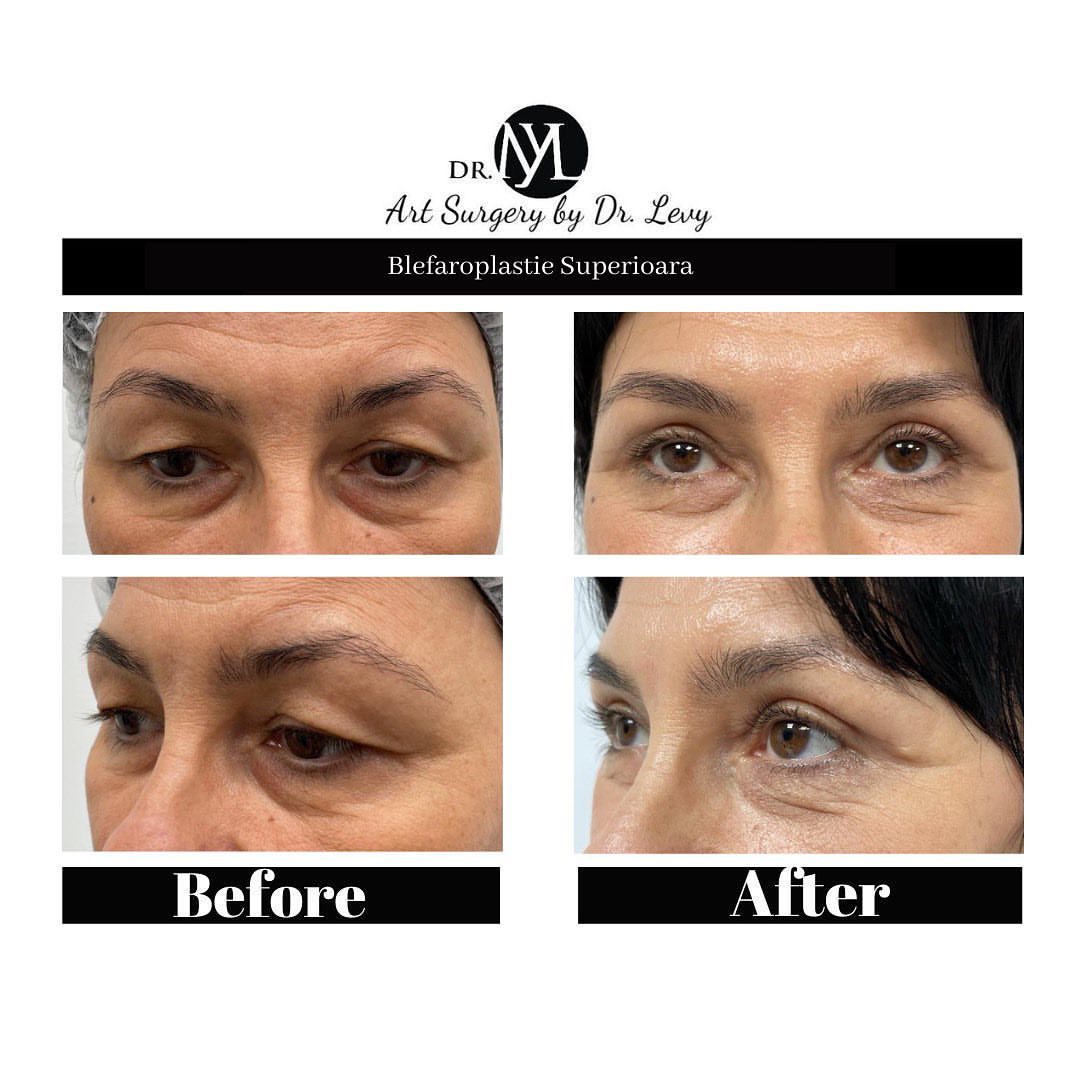poze operatie blefaroplastie superioara