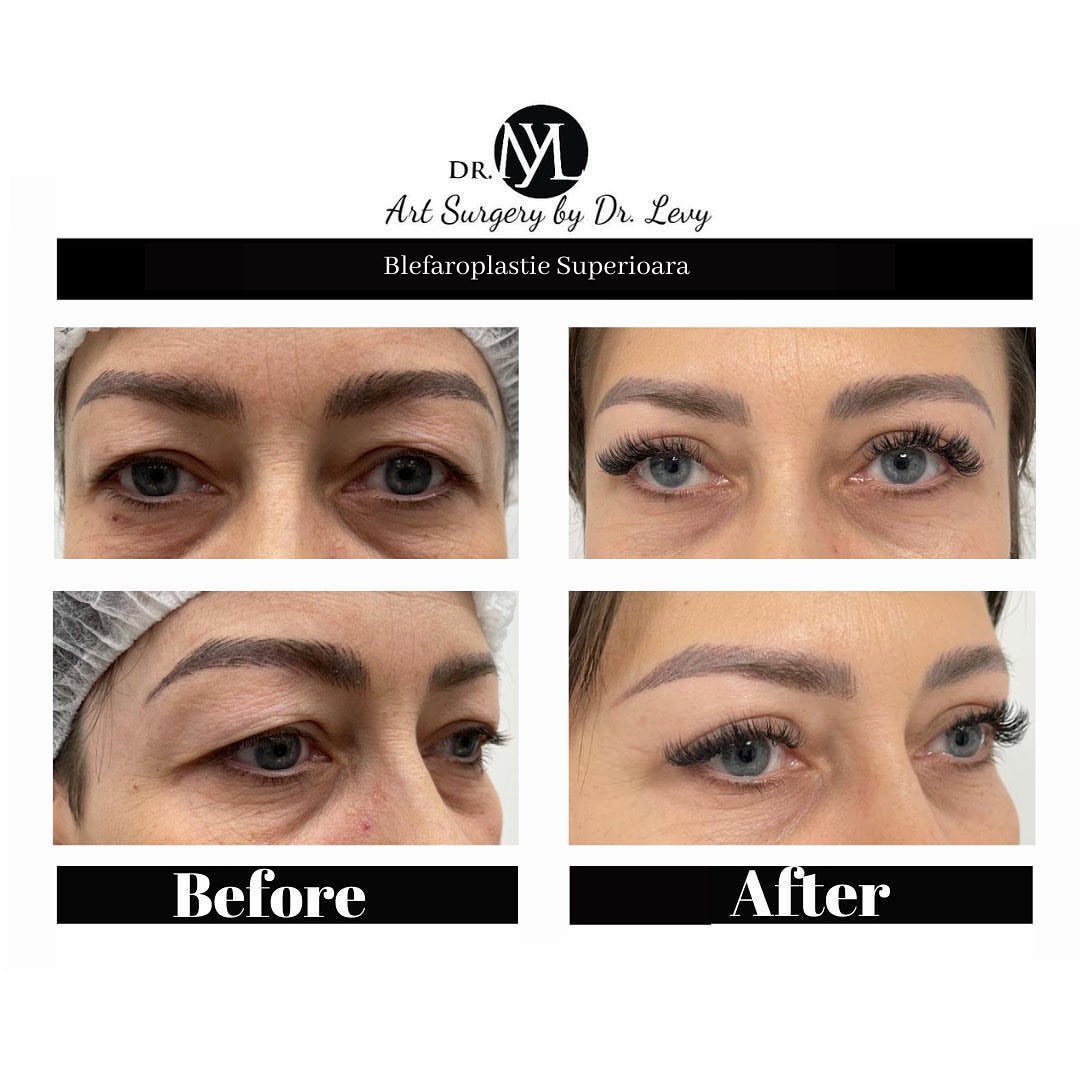 poze operatie blefaroplastie superioara
