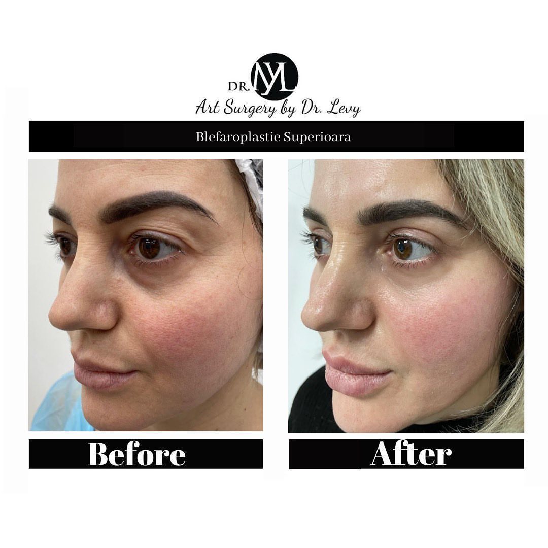 poze operatie blefaroplastie superioara
