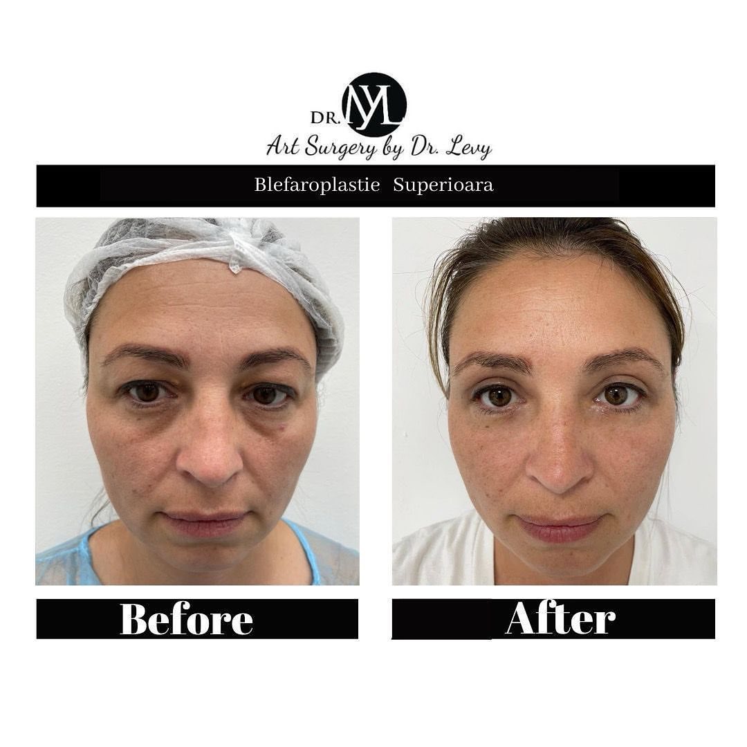 poze operatie blefaroplastie superioara