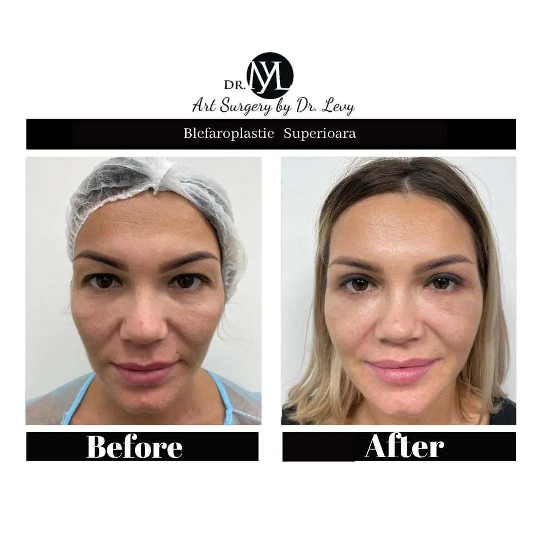 poze operatie blefaroplastie superioara